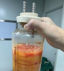 通化水动力吸脂手术要做多久？